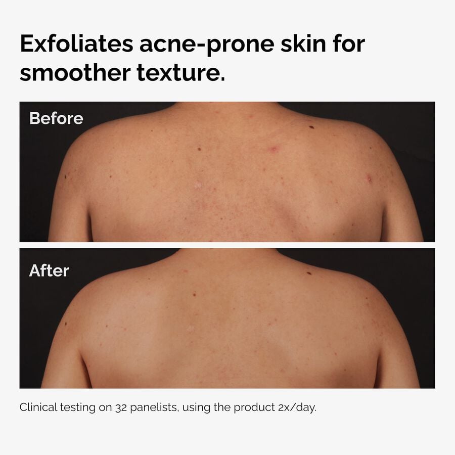 the-body-care-collection-j9 ord-salicylic-acid-body-serum-before-after-graphic-NA.jpg