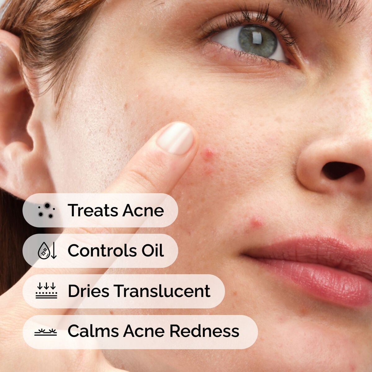 sulfur-10-powder-to-cream-concentrate-h2 ord-sulfur-10pct-powder-to-cream-concentrate-model-application-with-benefits-acne.jpg